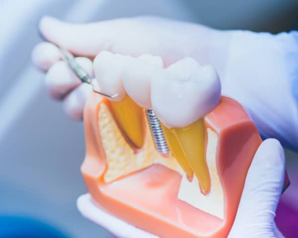 Dental Implant Procedure in Aubrey, TX